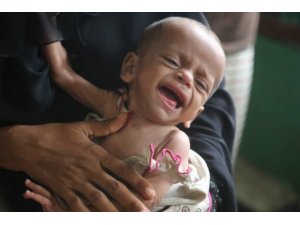 UNICEF’ten Yemen’de yetersiz beslenme sorunu yaşayan çocuklara yardım