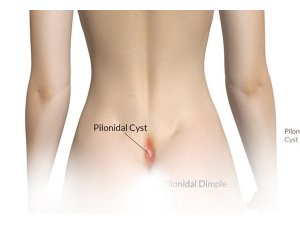 Mikrosinüsektomi yöntemiyle kıl dönmesi tedavisi