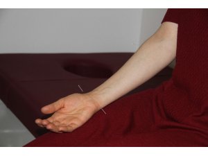 Isparta Şehir Hastanesi’nde akupunktur ile ilaçsız tedavi dönemi