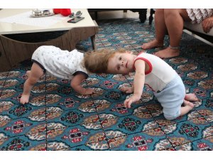 Kafadan yapışık siyam ikizleri 1 yaşında