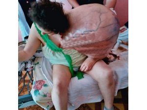 Hasta kadın omzundaki devasa tümörü taşıyamaz hale geldi