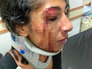 Çıkan olayda kafasına bardakla vurulan kadının yüzüne 6 dikiş atıldı,