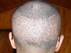 Sağlıksız saç ekimi ölüme sebep olabiliyor