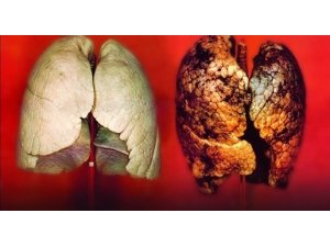 Sigara içmek akciğer sertleşmesinde başrol oynuyor