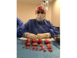 Bursa’da hastanın rahminden 21 miyom çıkarıldı