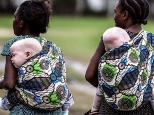 Tanzanya'da albinolu çocuklar büyü için ölüyor!