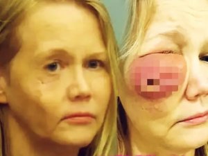 Dolgu yaptıran kadının son haline inanamayacaksınız: Yüzü delindi