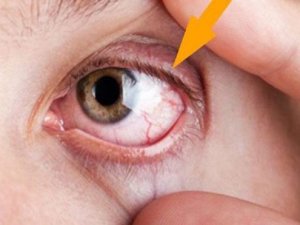 Cinsel yolla bulaşan enfeksiyonların olup olmadığını gözlerinizden anlayabilirsiniz