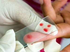 Sıtma tedavisi için yeni araştırmalar