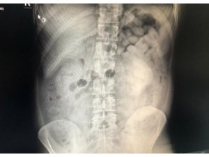 Diyarbakır’da şüpheli yolcunun midesinden 800 gram eroin çıktı