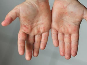 Kızamık vakalarında korkutan artış: İstanbul'da 2 çocuk hayatını kaybetti