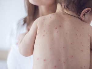 “1 yaş altı bebekler ağır kızamık için risk altında!”