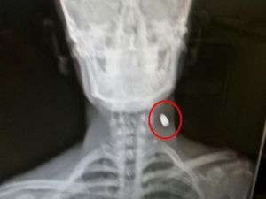 X-ray Cihazı İkaz Verince Boynunda Mermi Olduğu Ortaya Çıktı