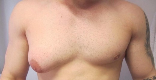 Jinekomasti Nedir, Nasıl Tedavi Edilir?
