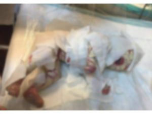 Milyonda bir görülen bir hastalıkla dünyaya geldi