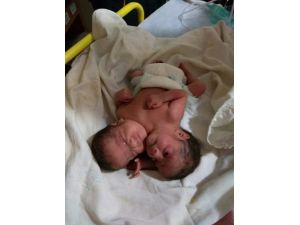 Suriye’de çift başlı bebek dünyaya geldi