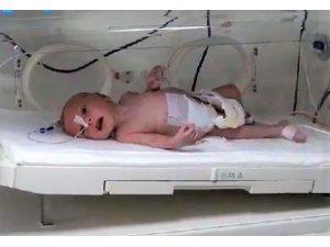 Yeni doğan bebeğin karnından 1 kilo 300 gram kitle çıkarıldı