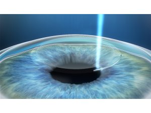 Lazerle göz tedavilerinde 3. Nesil Relex Smile Teknolojisi Dönemi