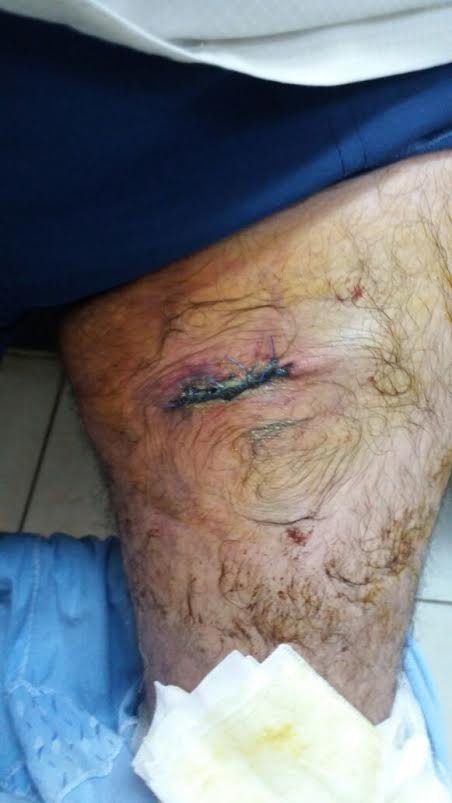 Darbe gecesi yaralı kurtulan vatandaş yaşadıklarını anlattı