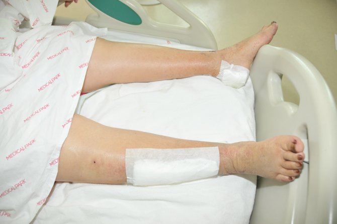 ‘Kesilecek’ denilen bacaklar girişimsel radyolojiyle kurtuldu