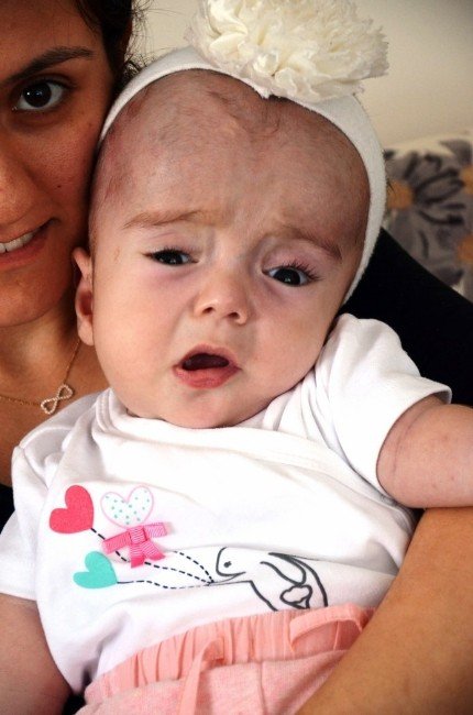Cam Kemik Hastası Efsa Bebek Yardım Bekliyor