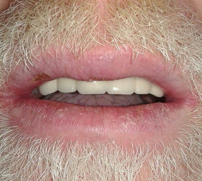 Dişleri Tamamen Çürüyen Hastaya Yeni Dişler Yapıldı