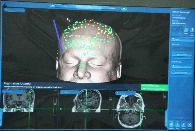 Beyin Cerrahisinde "Navigasyon" Teknolojisi