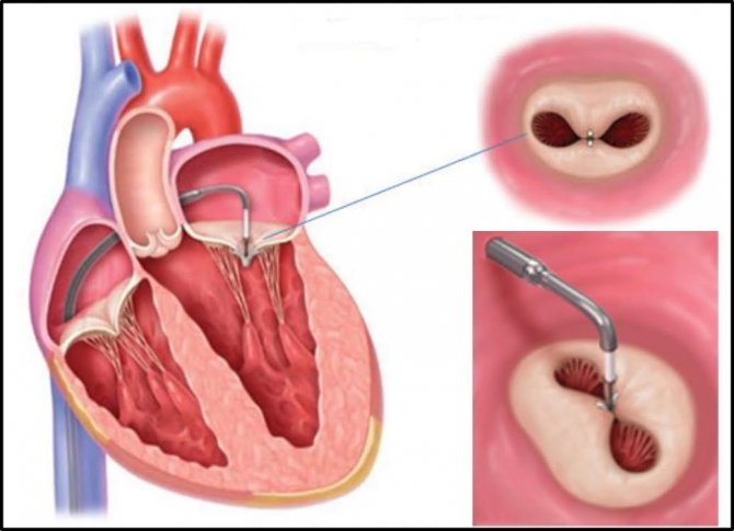 Açık ameliyatı kaldıramayan kalp hastalarına 'mitraclip' ile şifa