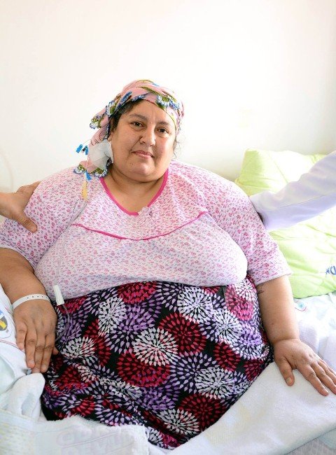 220 Kilo Olan Kadına Başarılı Mide Ameliyatı