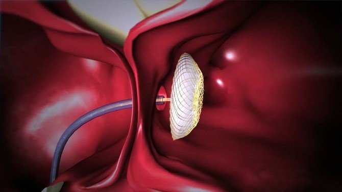 4 Santimlik Kalp Deliğine Cerrahisiz Müdahale