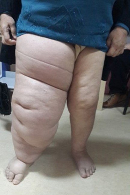 Lenfödemde erken tanının önemi