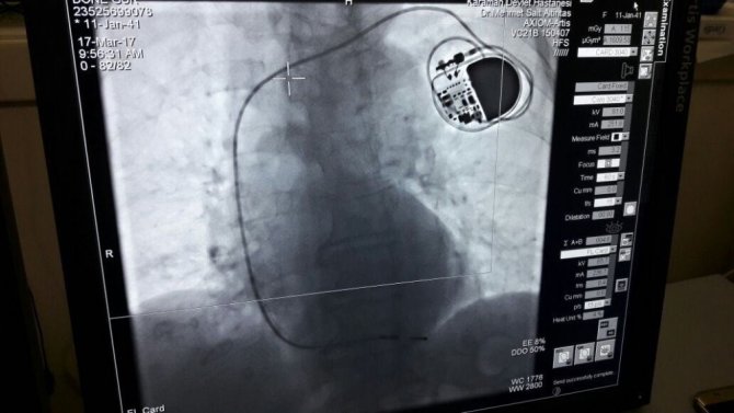 Karaman Devlet Hastanesinde ilk kez kalp pili takıldı