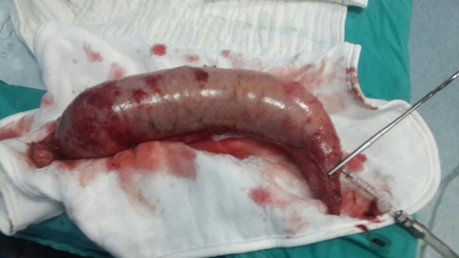 Bursa’da mide küçültme ameliyatları artık devlet hastanelerinde de yapılıyor