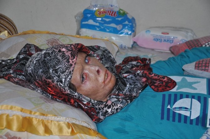 Esad’ın yaktığı Suriyeli Nuha Türkiye’de şifa buluyor