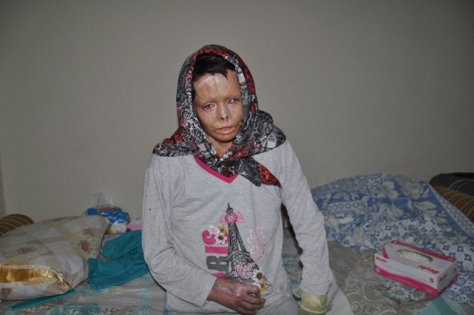 Esad’ın yaktığı Suriyeli Nuha Türkiye’de şifa buluyor