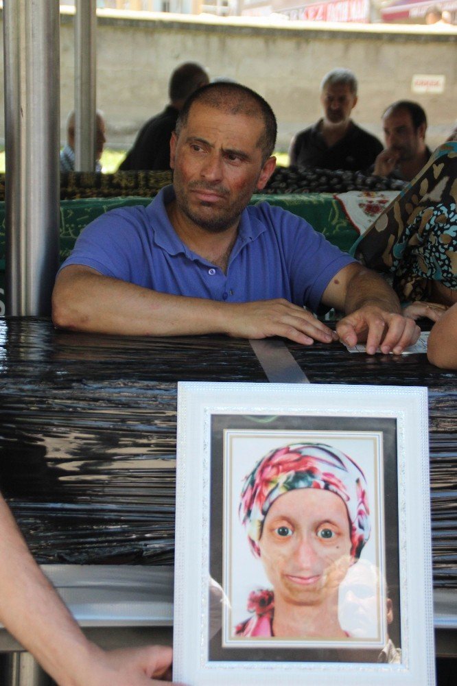 Hayatını kaybeden yaşlanma hastası Gamze son yolculuğuna uğurlandı