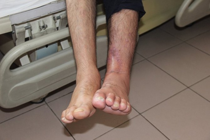 Ayağını makineye kaptırdı, 1 yıllık tedavinin ardından sağlığına kavuştu
