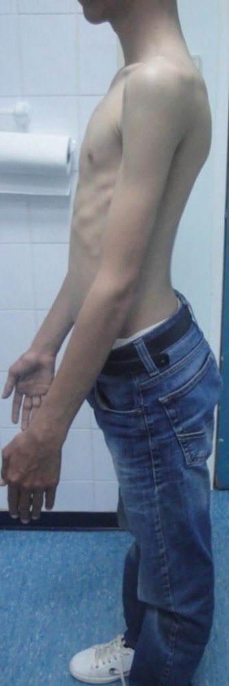 700. Skolyoz ve Kifoz ameliyatı