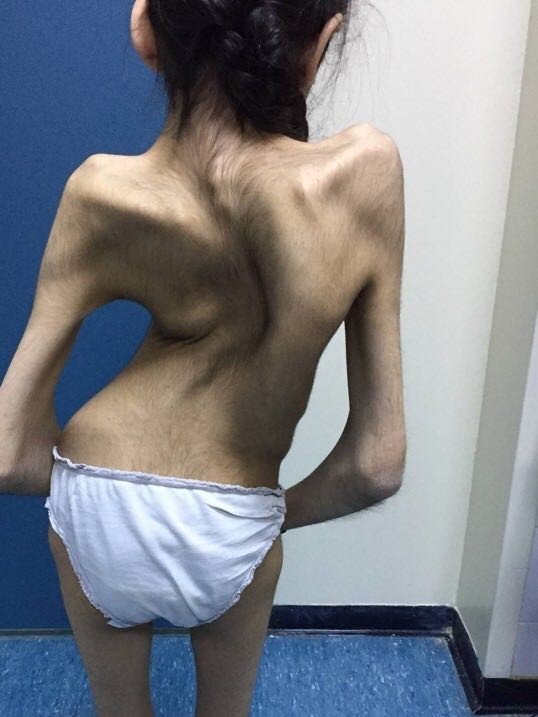 700. Skolyoz ve Kifoz ameliyatı