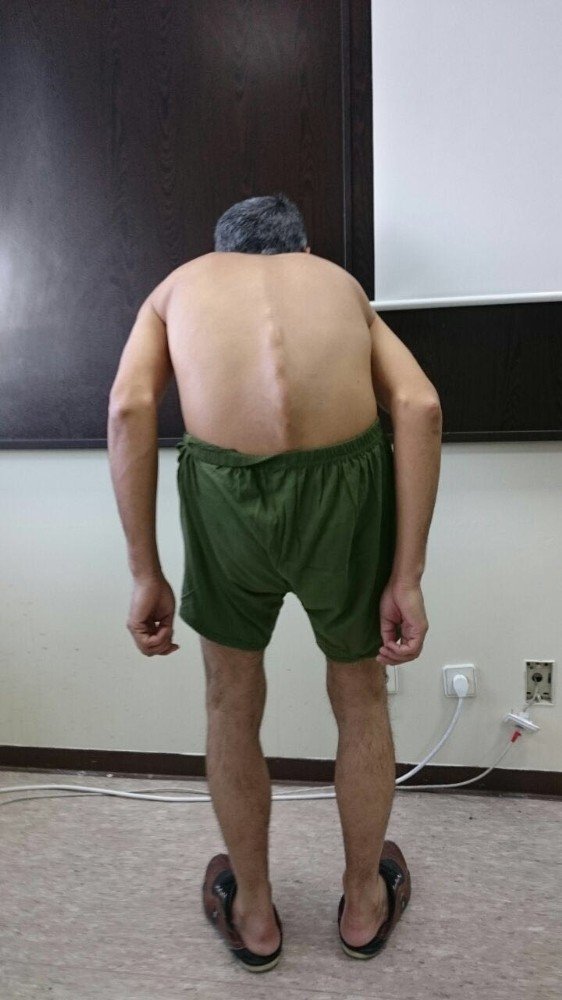 700. Skolyoz ve Kifoz ameliyatı