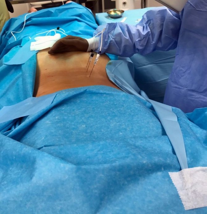 Bel ağrısına girişimsel tedavi