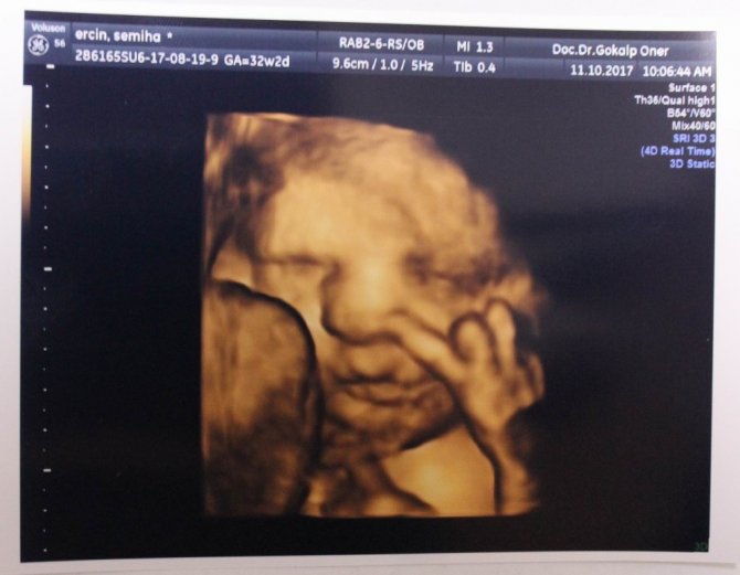 Daha anne karnında zafer işareti yaptı