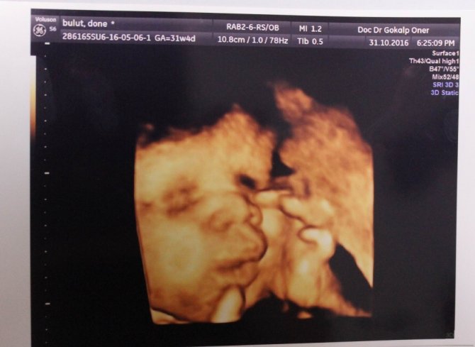 Daha anne karnında zafer işareti yaptı