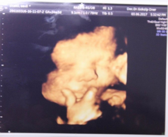 Daha anne karnında zafer işareti yaptı