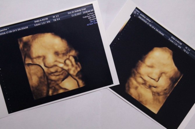 Daha anne karnında zafer işareti yaptı