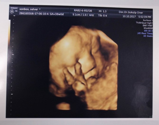 Daha anne karnında zafer işareti yaptı