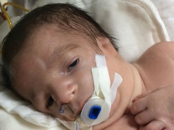 Treacher Collins sendromlu Baran bebek ilk doğum gününü doktorlarla kutladı
