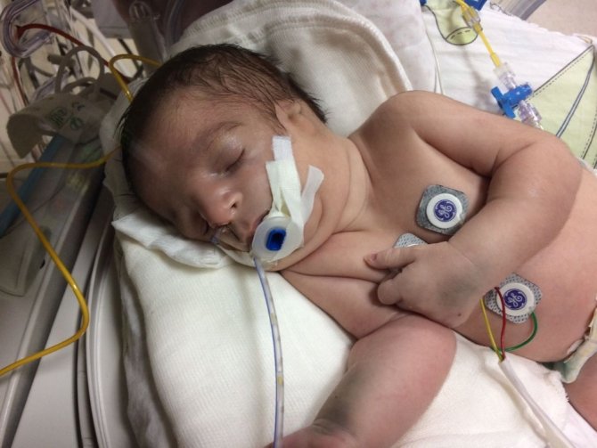 Treacher Collins sendromlu Baran bebek ilk doğum gününü doktorlarla kutladı