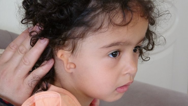 Doğuştan kulağı olmayan minik Zelal’in annesi yardım bekliyor