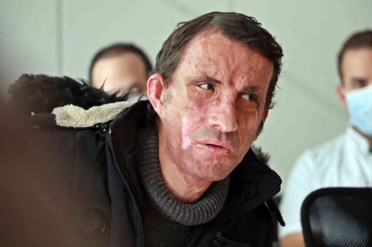 Türkiye’nin ilk yüz nakli 10 yaşında